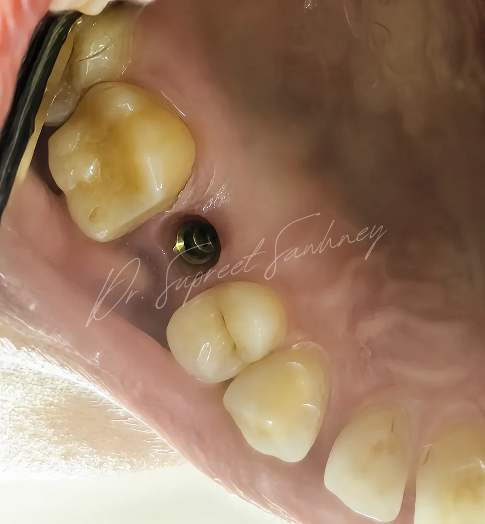 Occlusal intraoral photograph showing the access opening of a posterior maxillary dental implant